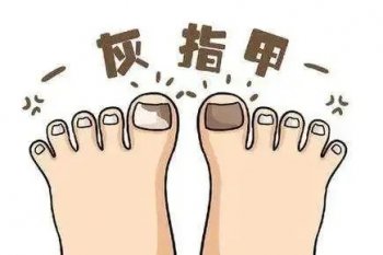 南京皮研所治疗灰指甲挂哪个医生