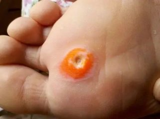 南京市哪所医院治疗鸡眼